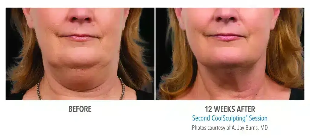 how-to-get-rid-of-a-double-chin-coolsculpting-1-1024x458