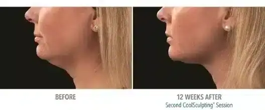 how-to-get-rid-of-a-double-chin-coolsculpting-5-528x220
