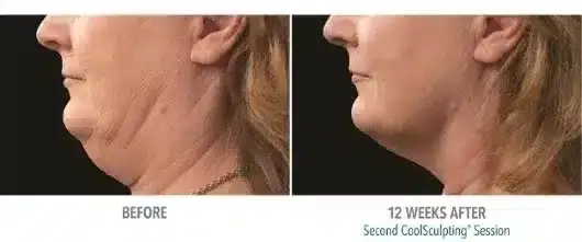 how-to-get-rid-of-a-double-chin-coolsculpting-skinney-medspa-2-530x221