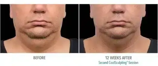 how-to-get-rid-of-a-double-chin-coolsculpting-skinney-medspa-3-532x222