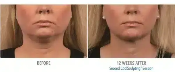 how-to-get-rid-of-a-double-chin-coolsculpting-skinney-medspa-4-600x250