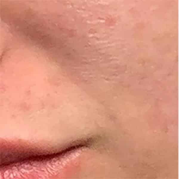 After RF Microneedling treatment with Morpheus8at Skinney Medspa New York, Miami, Houston