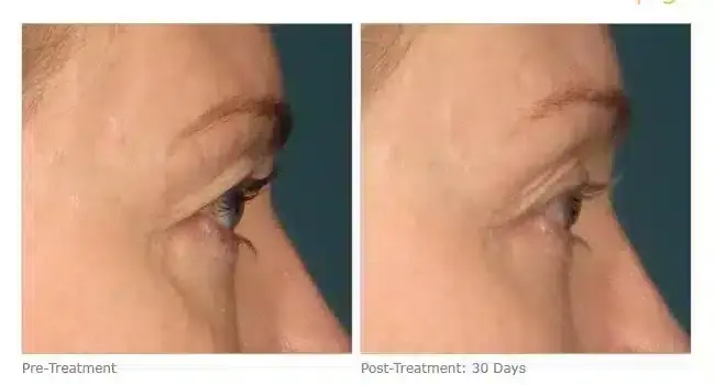 ultherapy-000k-004y_before-30daysafter_brow-800x350