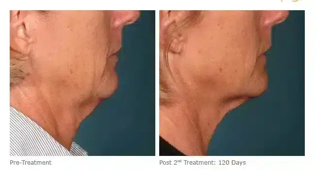 ultherapy-000l-005y_before-120daysafter-2tx_lower-800x350