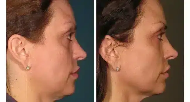 ultherapy-000p-015y_before-360daysafter_full-1-800x350