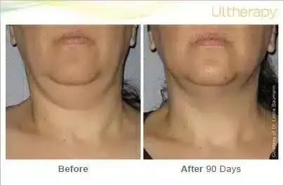 ultherapy-0014-0086w_beforeandafter_90day_1tx_neck-800x350