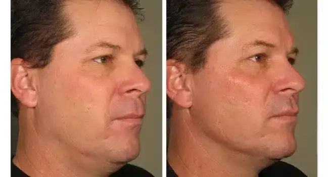 ultherapy-0058d_before-120daysafter_full-800x350