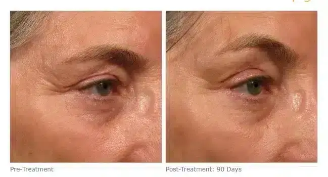 ultherapy-005a-018y_before-90daysafter_brow-800x350