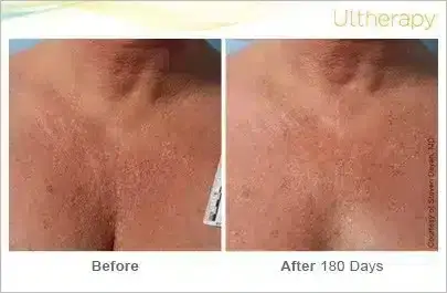 ultherapy_031lmm_beforeandafter-180day_1tx_chest-800x350
